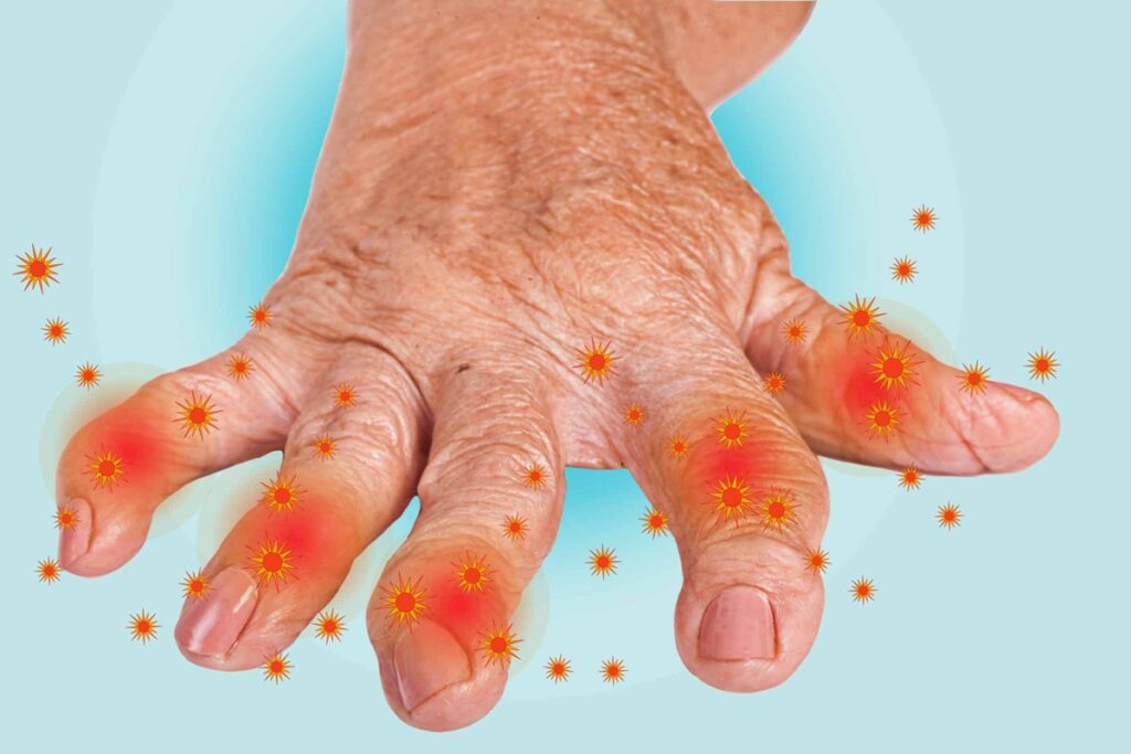 Arthritis symptoms