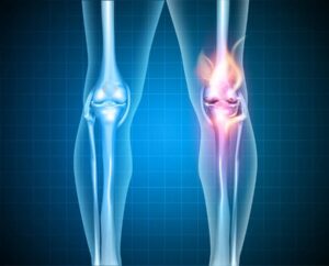 Arthritis symptoms