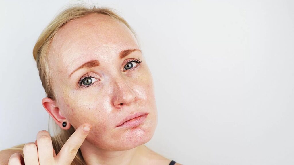 Oily skin remedies